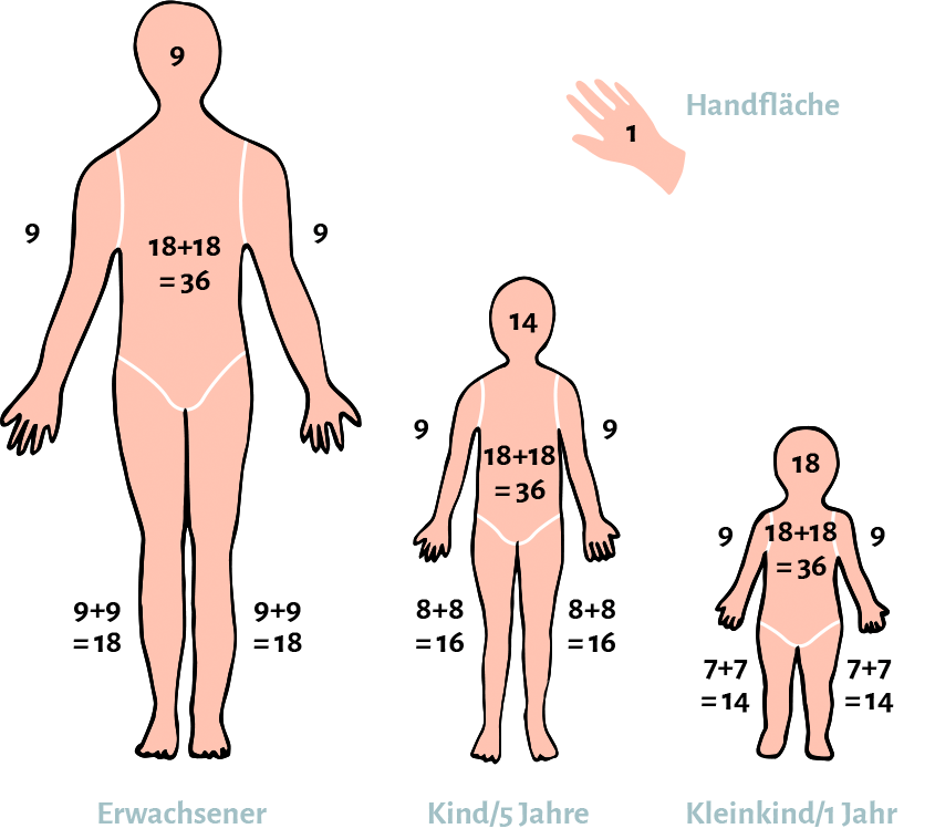 Verbrennungen und Verbrühungen bei Baby und Kleinkind anhand der Körperoberfläche